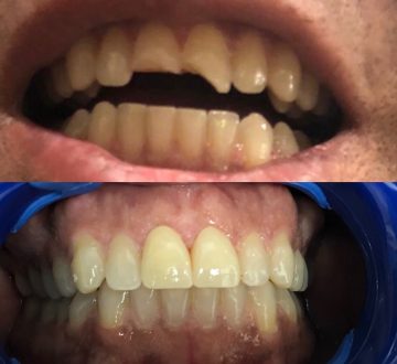 Teeth photo of before and after