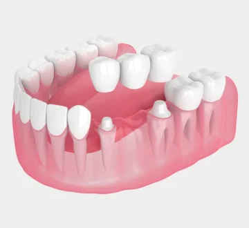 Delaying a Dental Bridge: What Happens If You Wait?